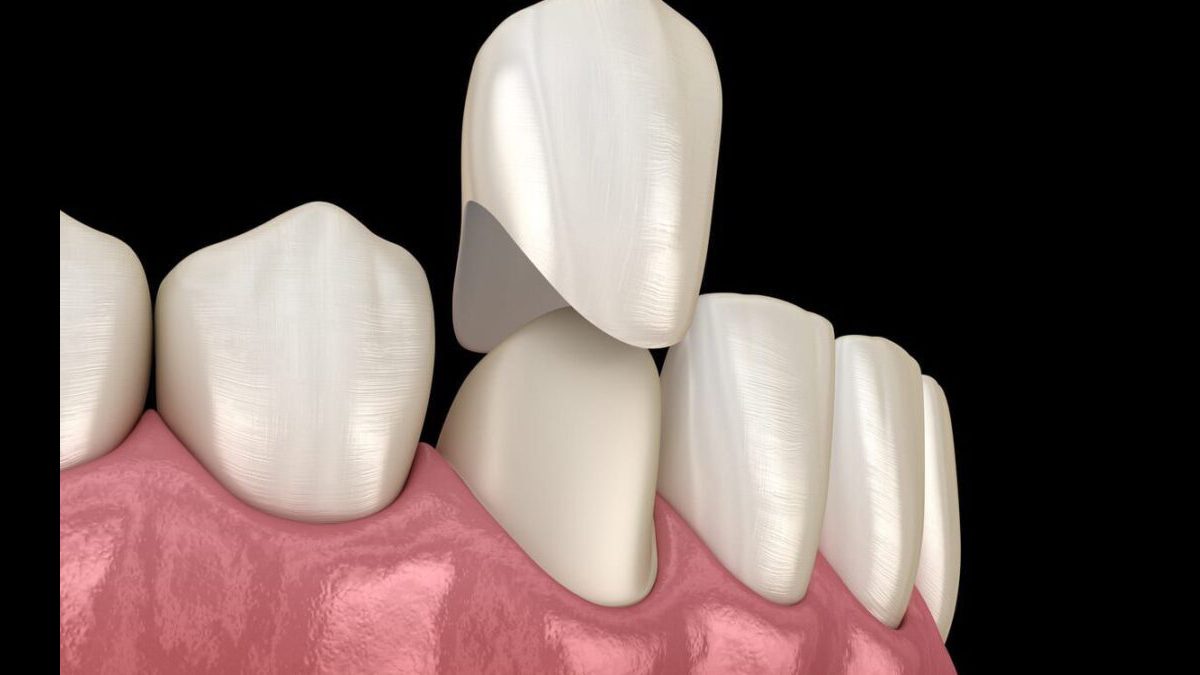 Understanding Why Your Dental Crown Hurts When Biting Down