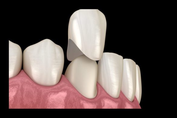 Understanding Why Your Dental Crown Hurts When Biting Down